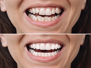 Factors that affect the cost of gold braces include how crooked your teeth are and how much movement is needed in your smile