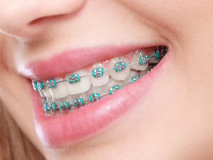 Close-up of woman’s teeth with braces