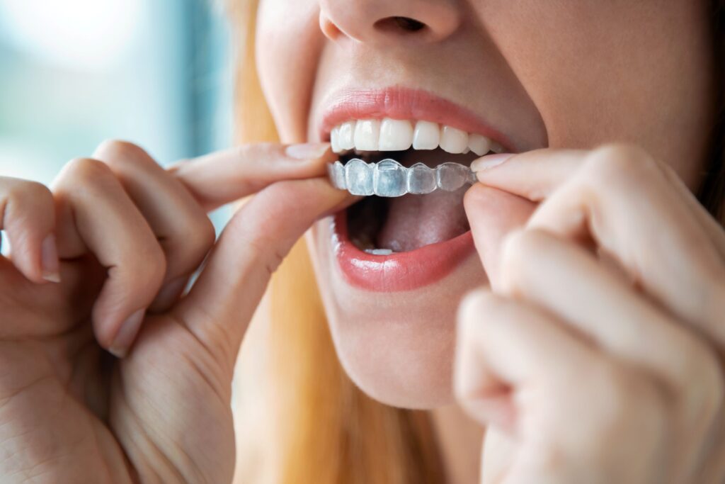 Woman placing Invisalign over upper arch